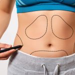 erro médico em abdominoplastia